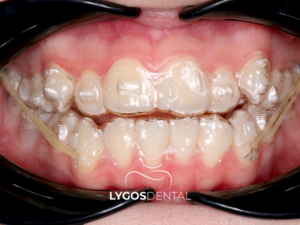 Plak Tedavisi 3 Plak Tedavisi