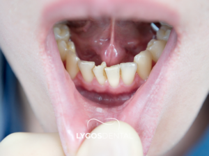 Plak Tedavisi 2 Plak Tedavisi