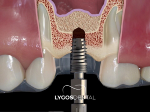 Sinüs Lift 3 Sinüs Lift