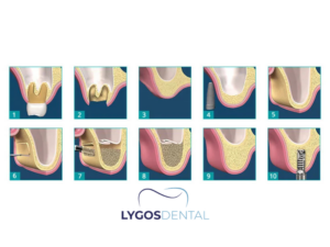 Sinüs Lift 2 Sinüs Lift