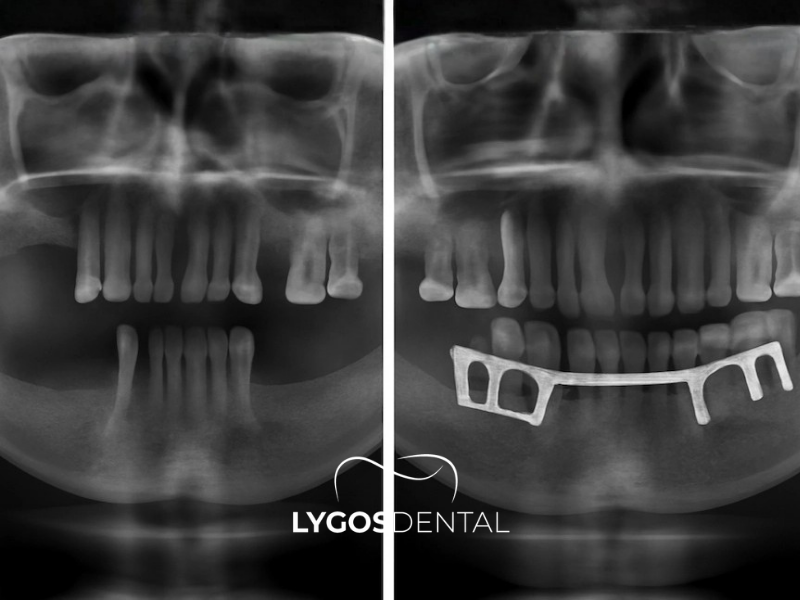 Субпериостальный имплантат 2 Subperiostal İmplant Neden Özel Bir Tedavi Seçeneğidir