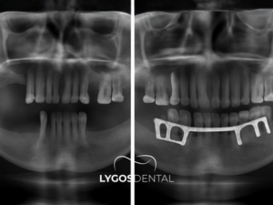 Subperiostal İmplant