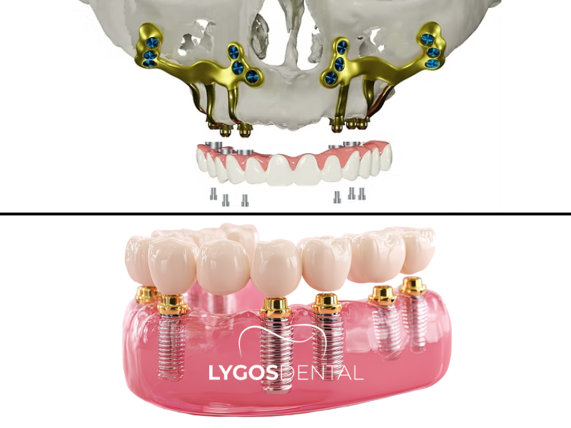 Субпериостальный имплантат 1 Subperiostal İmplant ile Klasik İmplant Arasındaki Fark Nedir