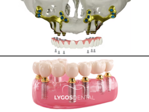 Subperiostal İmplant
