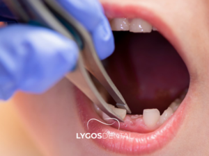 Süt Dişi Çekimi 2 Süt Dişi Çekimi