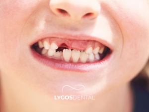 Süt Dişi Çekimi 3 Süt Dişi Çekimi