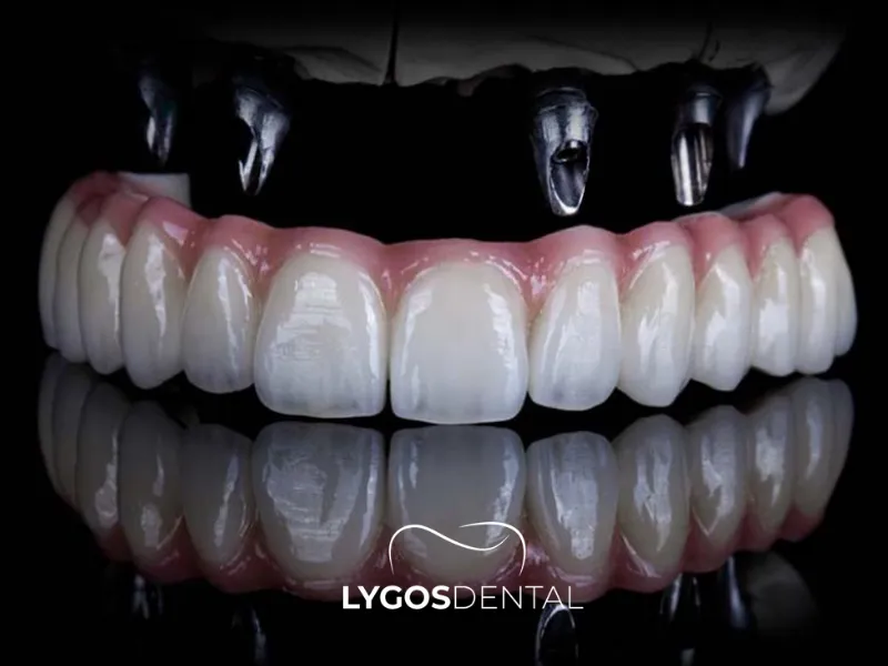 Имплантация на всю челюсть