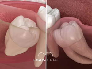 Gömülü Diş Çekimi 2 Gömülü Diş Çekimi