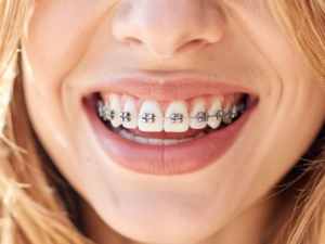 Ortodontik Tedavi 4 Ortodontik Tedavi