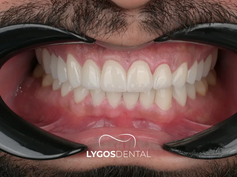 Zirkonyum Dişlerin Doku Uyumu