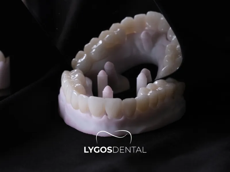 Zirkonyum Kaplama Fiyatları 2026