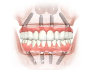 All-on-4 Implant