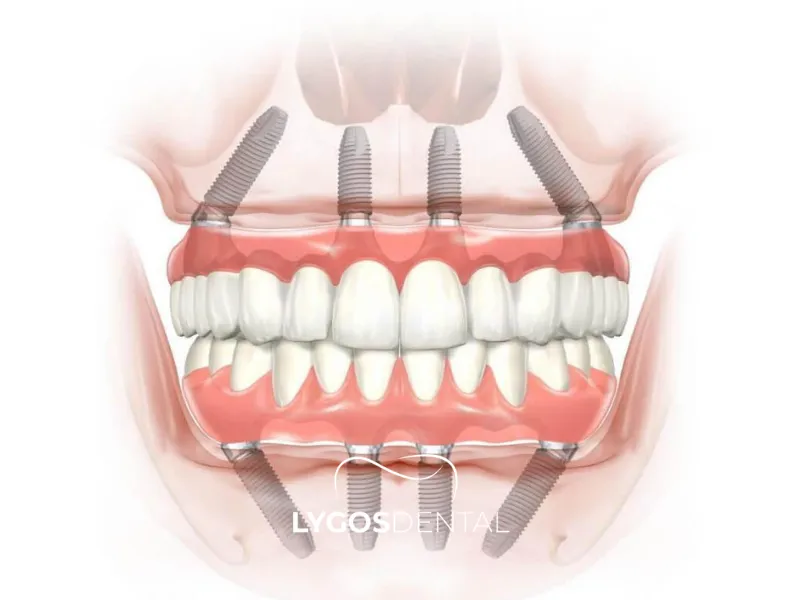 Имплант „All-on-4“