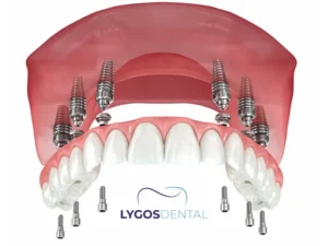 All-on-6 Implant