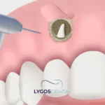 Апикоэктомия