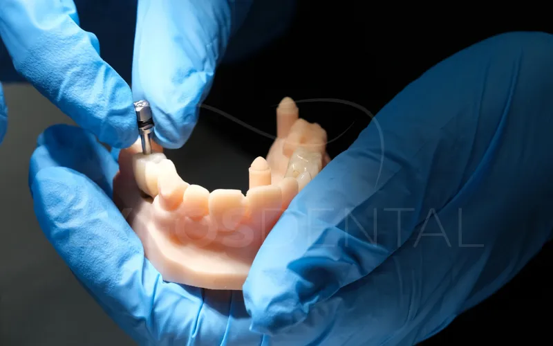 Implantes Dentales Avanzados