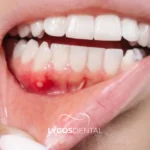 Лечение заболеваний десен