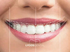 Smile Design Turkey