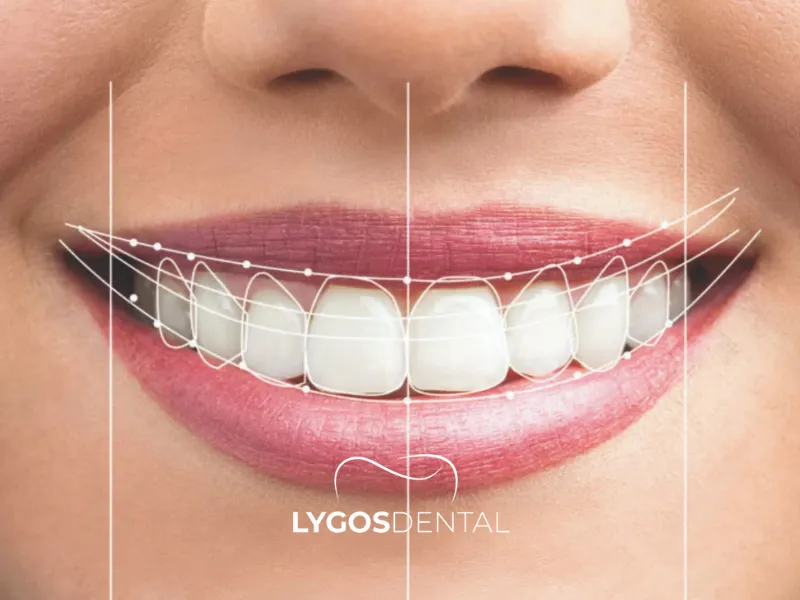 Smile Design Турция