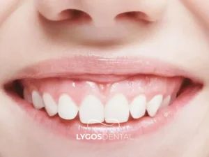 Gummy Smile Treatment Turkey