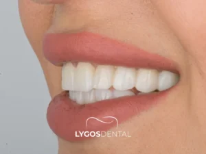 Hollywood Smile Turkey