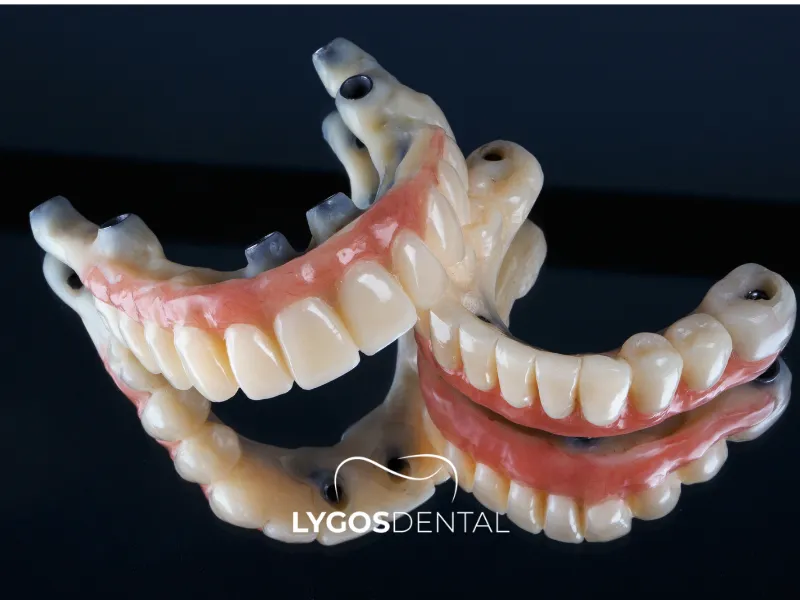 Протеза, поддържана от импланти