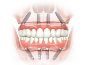 All On Four 1 All On Four