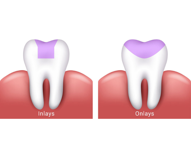 İnley ve Onley Dolgu