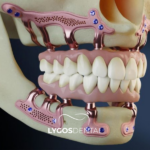 Subperiostal İmplant