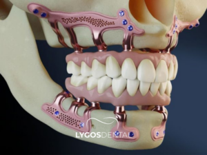 Subperiostal İmplant