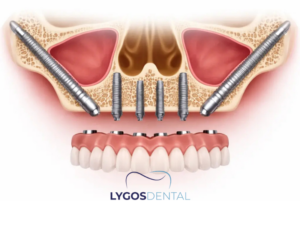 Zigoma İmplant 1 Zigoma İmplant