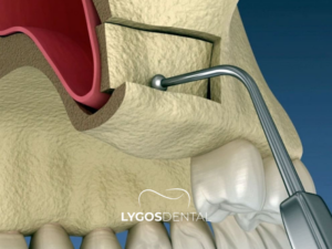 Sinüs Lift 1 Sinüs Lift