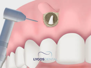 Apikoektomi 1 Apikoektomi