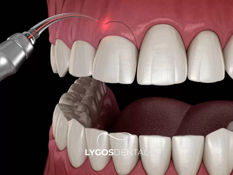 Diş Eti Şekillendirme