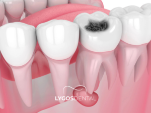 Diş Lezyonu 1 Diş Lezyonu