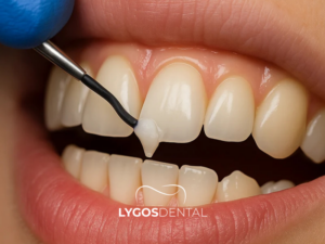 Kompozit Bonding 1 Kompozit Bonding