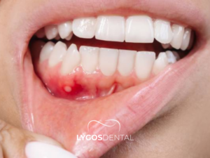 Diş Eti Hastalığı Tedavisi