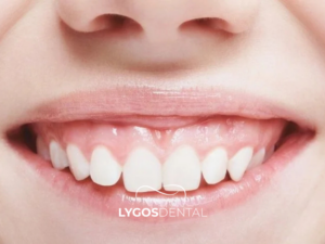 Gummy Smile Tedavisi