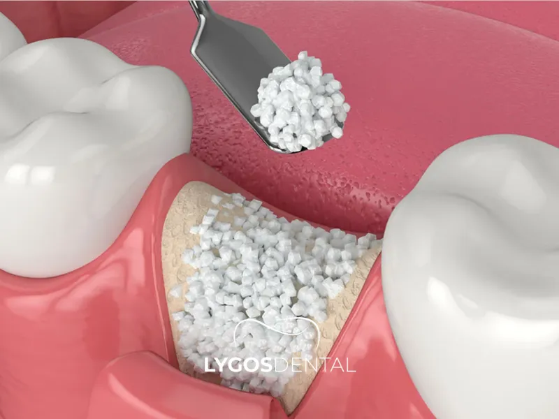 Костный трансплантат