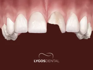Broken Tooth Treatment