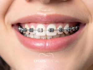 Orthodontic Treatment