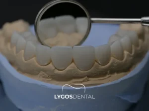 Porcelain Crown