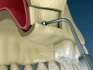 Sinus Lift