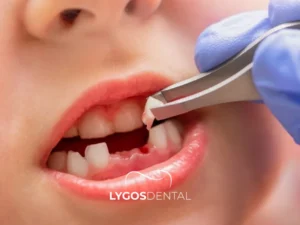 Primary Tooth Extraction