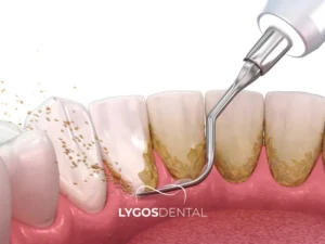 Tartar Treatment