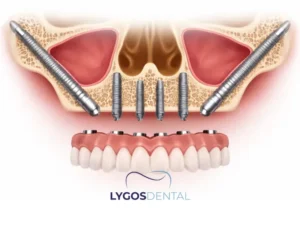 Zygoma Implant