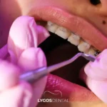 Beşiktaş Diş Teli Ücreti: Fiyatı Belirleyen Detaylar