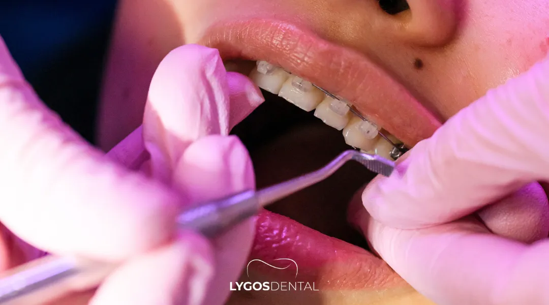 Beşiktaş Diş Teli Ücreti: Fiyatı Belirleyen Detaylar