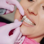 Beşiktaş Porcelain Veneers: A Practical Guide
