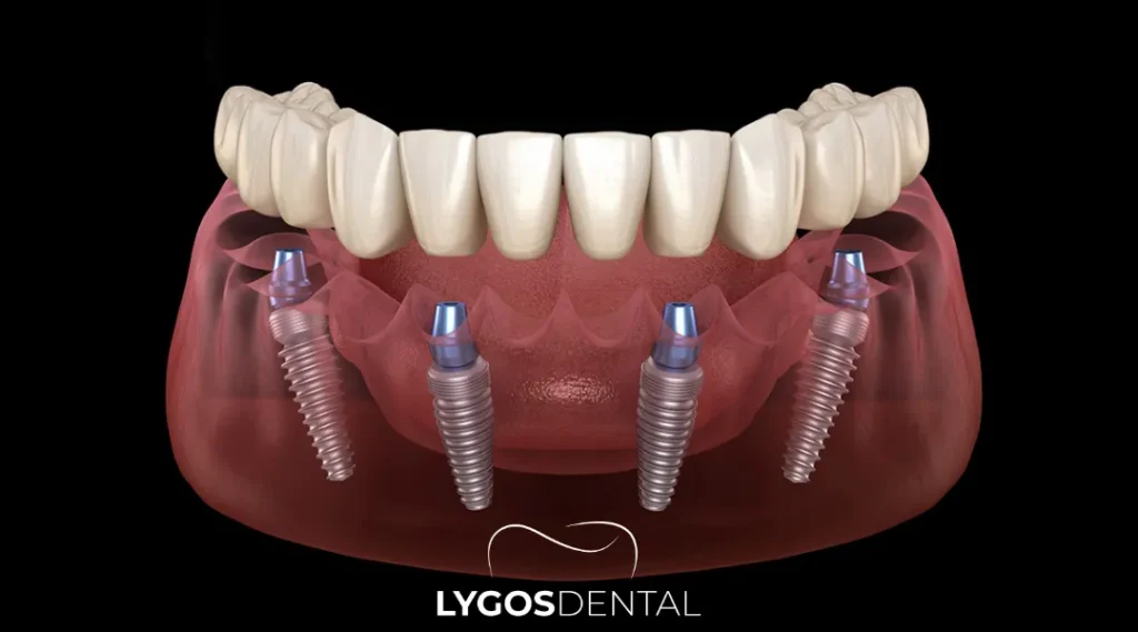 Dental Implants in Bakırköy: What to Know